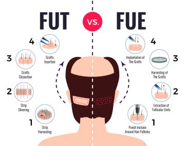 تفاوت کاشت مو به روش FUE با کاشت مو به روش FUT