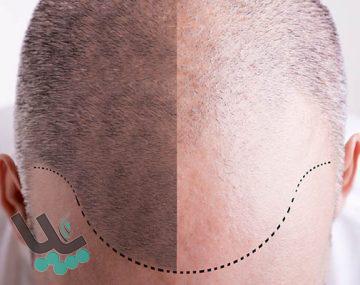 مقایسه روش های کاشت مو